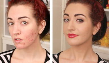 Makeup for Pitted Acne Scars Before After