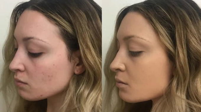 Covering Acne Scars Using Concealer Makeup 