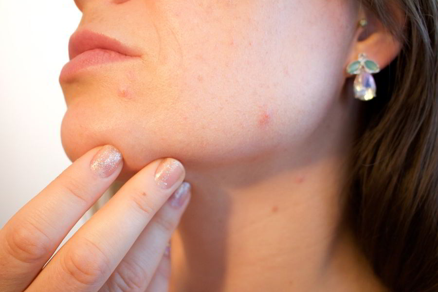 Most Common causes of pimples